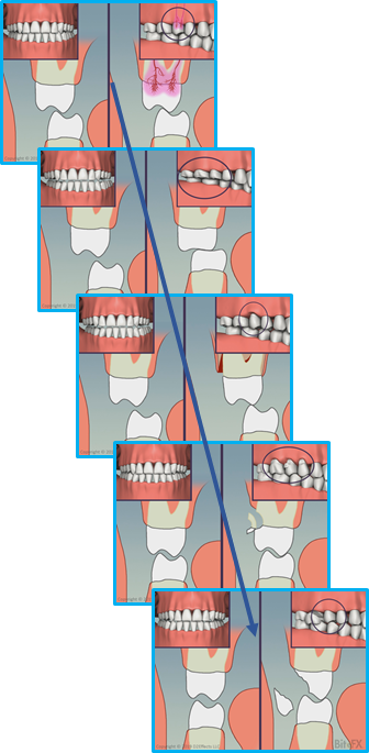 Molars-Guidance-Comparison-with-Insets-Combo