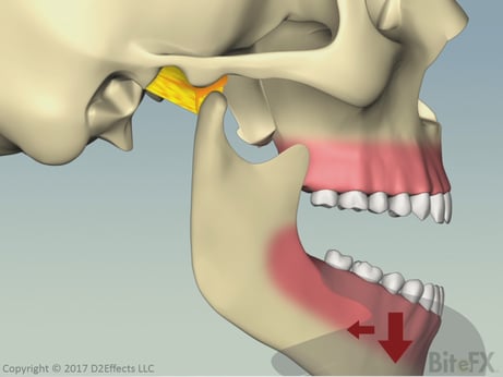Subluxation-Of-The-Temporomandibular-Joint.png